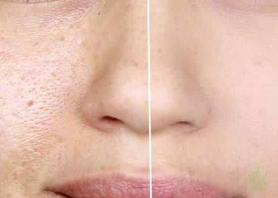 tẩy tế bào chết của laxanhbeauty