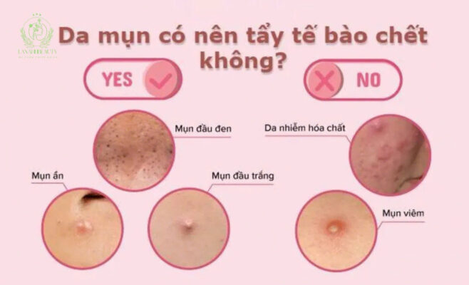 tẩy tế bào chết cho da dầu mụn của laxanhbeauty